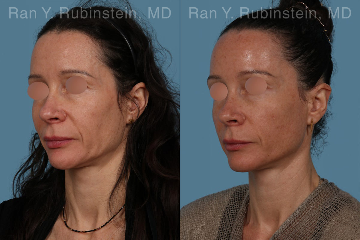 Sculptra Face Before and After Photos in Montvale, NJ, Patient 30699