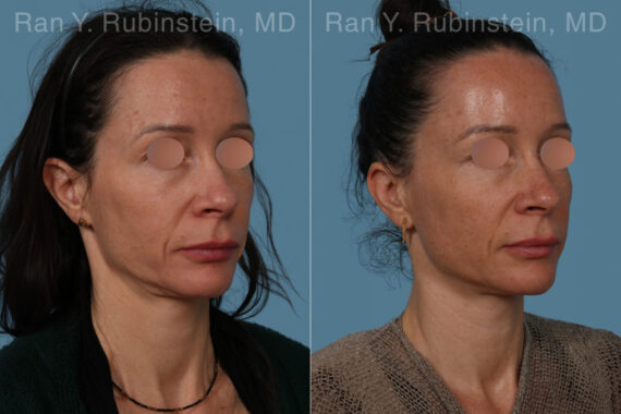Sculptra Face Before and After Photos in Montvale, NJ, Patient 30699