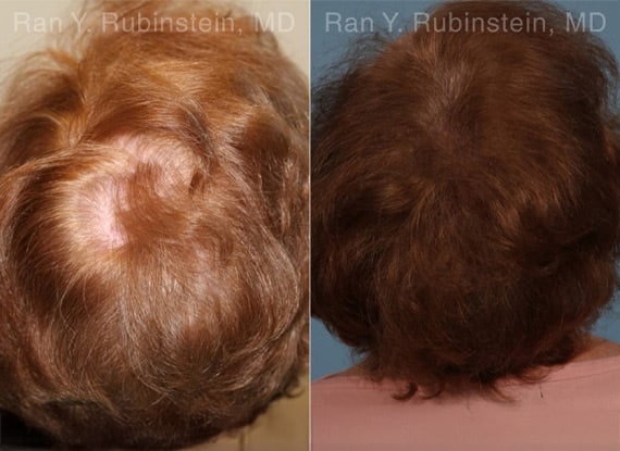 PRP Hair Restoration Before & After Photos