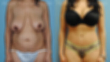 Abdominoplasty Before and After Photos in Montvale, NJ, Patient 12236