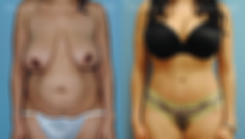 Abdominoplasty Before and After Photos in Montvale, NJ, Patient 12236