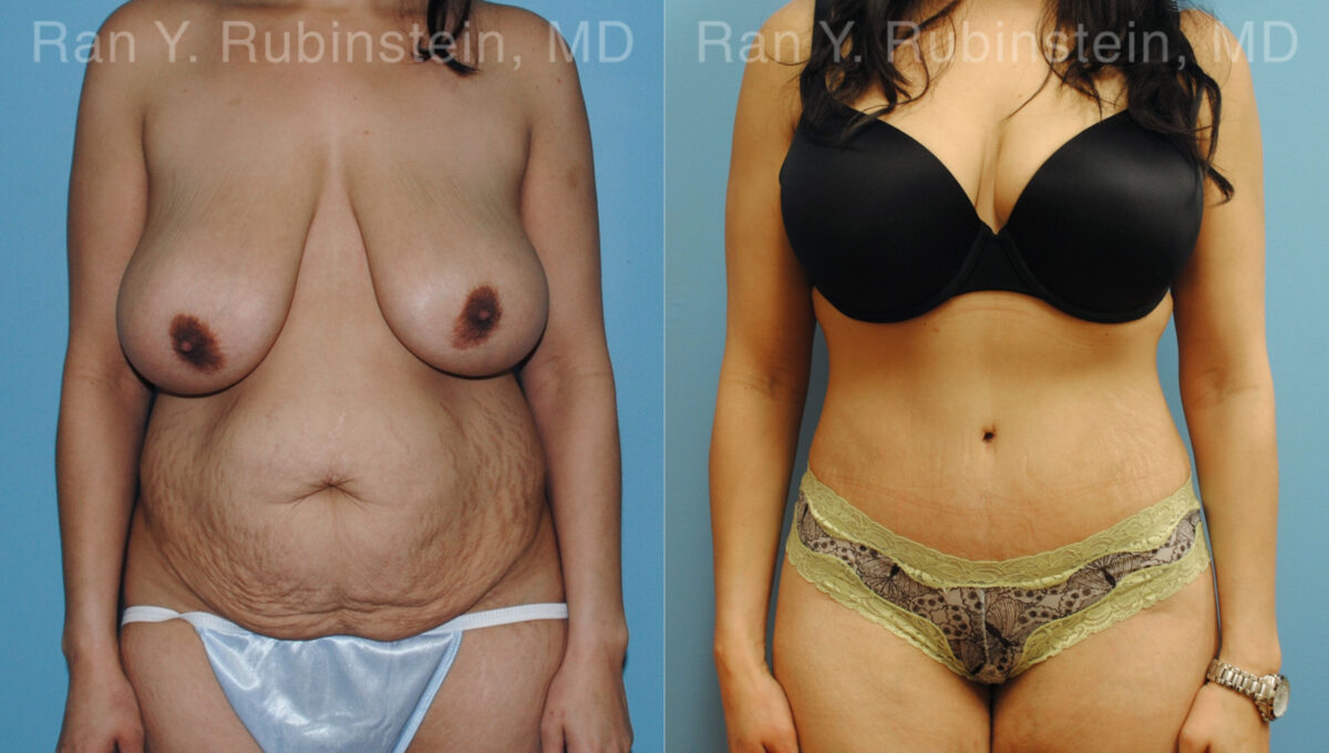 Abdominoplasty Before and After Photos in Montvale, NJ, Patient 12236