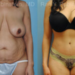 Abdominoplasty Before and After Photos in Montvale, NJ, Patient 12236