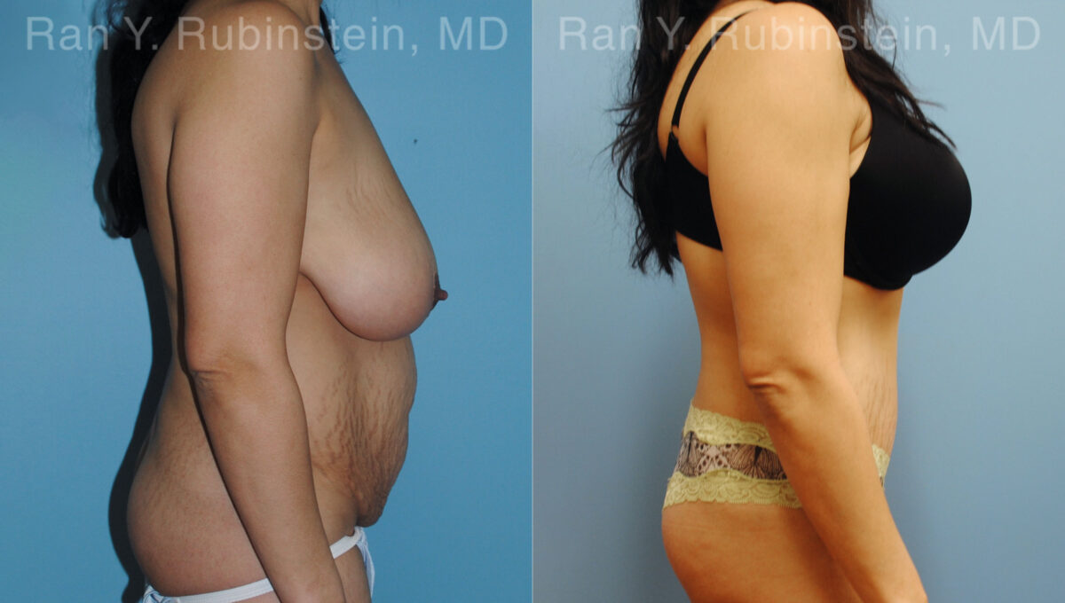 Abdominoplasty Before and After Photos in Montvale, NJ, Patient 12236