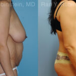 Abdominoplasty Before and After Photos in Montvale, NJ, Patient 12236