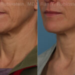 Radiesse Before and After Photos in Montvale, NJ, Patient 26409