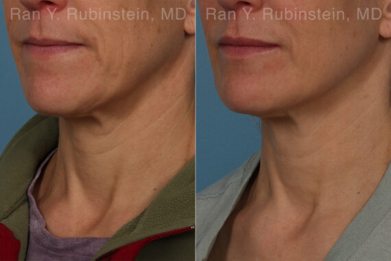 Radiesse Before and After Photos in Montvale, NJ, Patient 26409