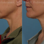 Radiesse Before and After Photos in Montvale, NJ, Patient 26409