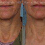 Radiesse Before and After Photos in Montvale, NJ, Patient 26409
