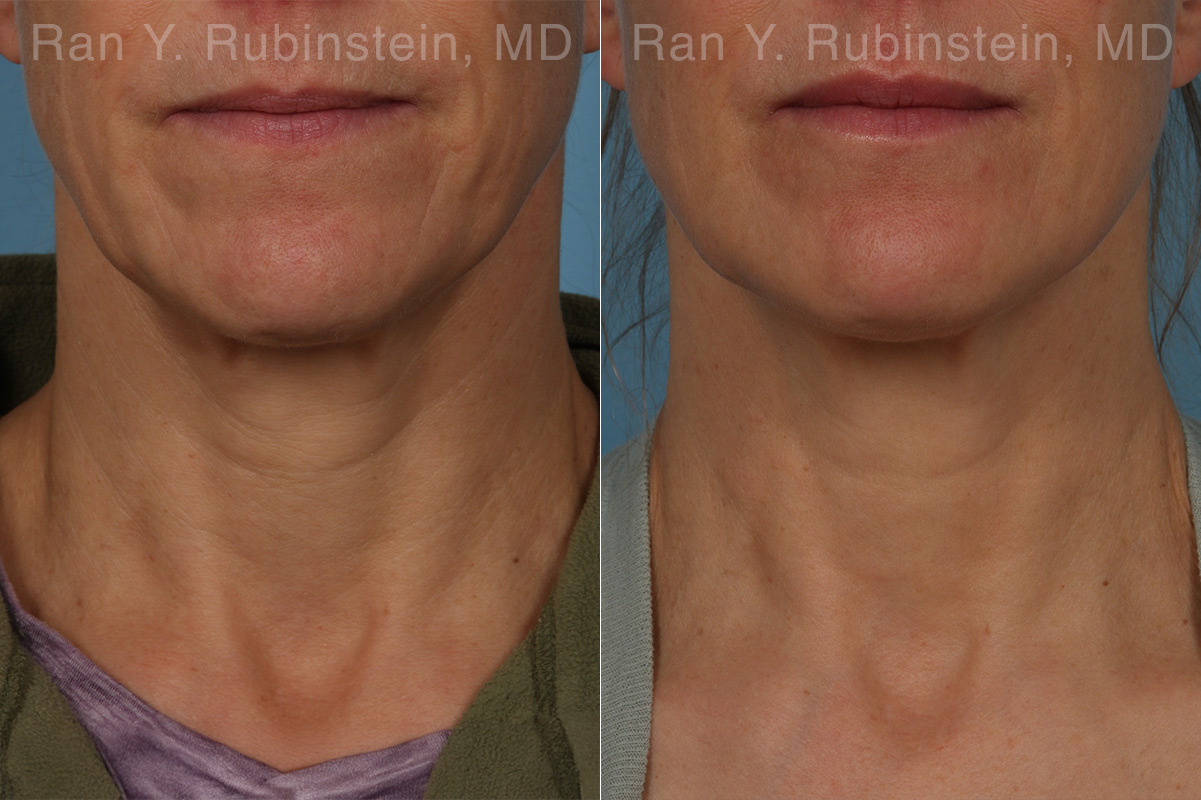 patient-26409-sculptra-face-before-after