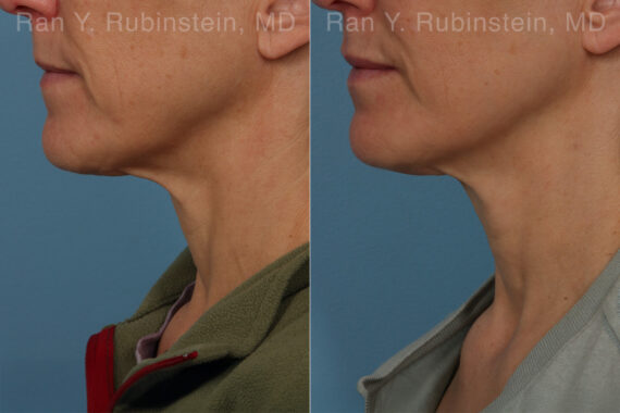 Radiesse Before and After Photos in Montvale, NJ, Patient 26409