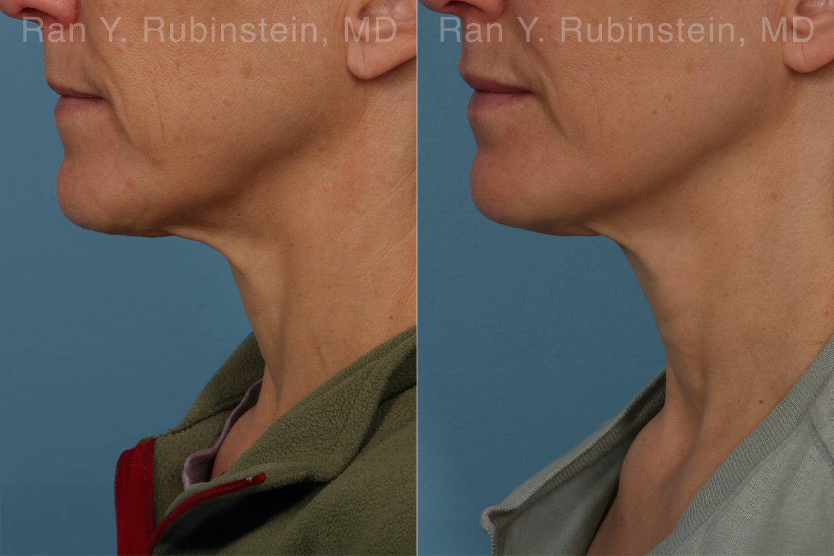patient-26409-sculptra-face-before-after