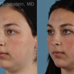 Dermal Fillers Before and After Photos in Montvale, NJ, Patient 31295