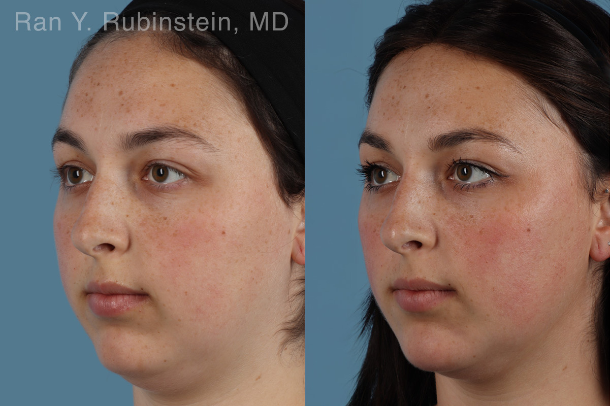 Dermal Fillers Before and After Photos in Montvale, NJ, Patient 31295
