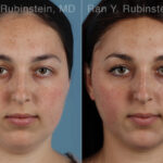 Dermal Fillers Before and After Photos in Montvale, NJ, Patient 31295