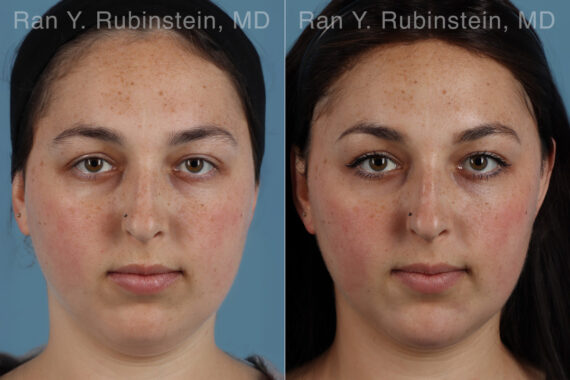 Dermal Fillers Before and After Photos in Montvale, NJ, Patient 31295