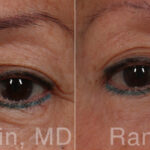 Eyelid Surgery Before and After Photos in Montvale, NJ, Patient 31302