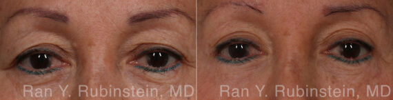 Eyelid Surgery Before and After Photos in Montvale, NJ, Patient 31302