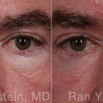 Eyelid Surgery Before and After Photos in Montvale, NJ, Patient 31306