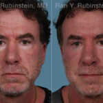 Eyelid Surgery Before and After Photos in Montvale, NJ, Patient 31306