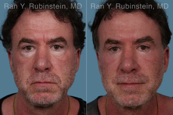 Eyelid Surgery Before and After Photos in Montvale, NJ, Patient 31306