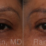 Brow Lift Before and After Photos in Montvale, NJ, Patient 31320