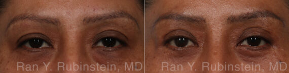 Brow Lift Before and After Photos in Montvale, NJ, Patient 31320