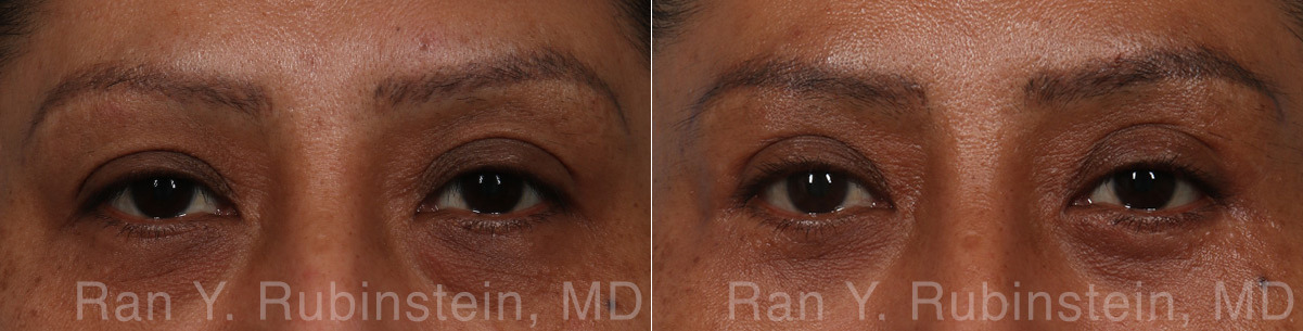 Brow Lift Before and After Photos in Montvale, NJ, Patient 31320