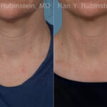 Radiesse Before and After Photos in Montvale, NJ, Patient 31387