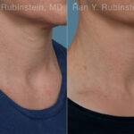Radiesse Before and After Photos in Montvale, NJ, Patient 31387