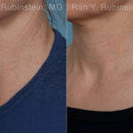 Radiesse Before and After Photos in Montvale, NJ, Patient 31387
