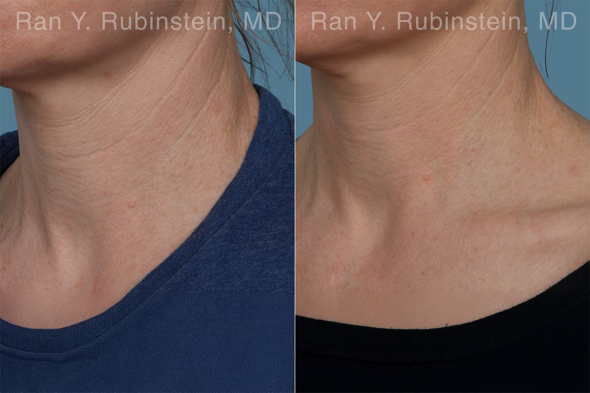 Radiesse Before and After Photos in Montvale, NJ, Patient 31387