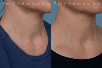Radiesse Before and After Photos in Montvale, NJ, Patient 31387