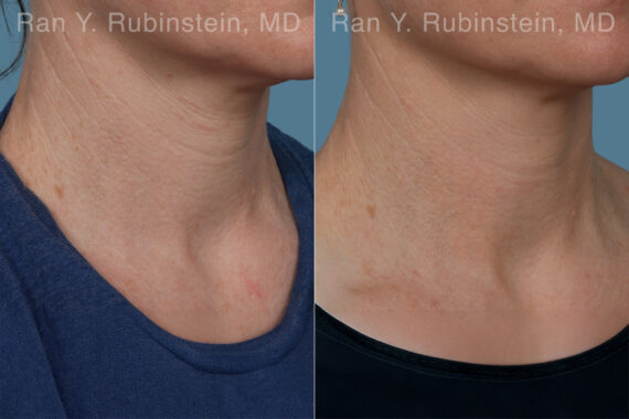 Radiesse Before and After Photos in Montvale, NJ, Patient 31387