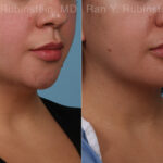 Chin Augmentation Before and After Photos in Montvale, NJ, Patient 31521