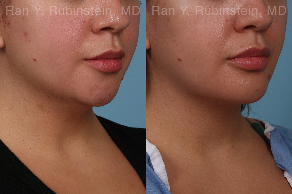 Chin Augmentation Before and After Photos in Montvale, NJ, Patient 31521