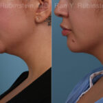 Chin Augmentation Before and After Photos in Montvale, NJ, Patient 31521