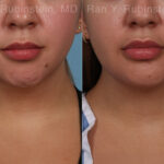 Chin Augmentation Before and After Photos in Montvale, NJ, Patient 31521