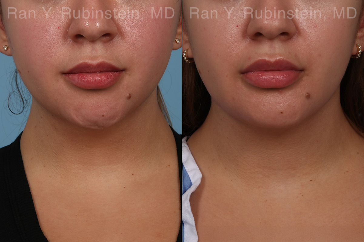 Chin Augmentation Before and After Photos in Montvale, NJ, Patient 31521