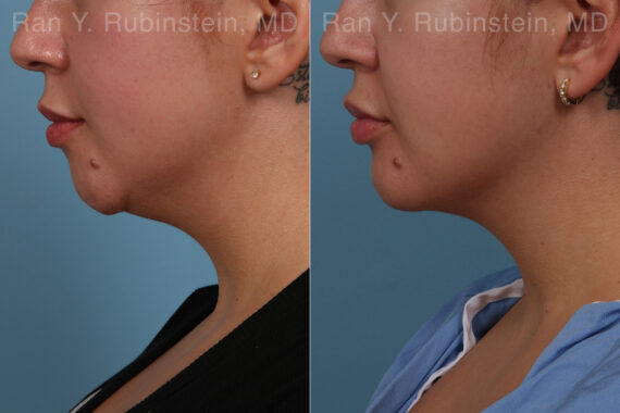 Chin Augmentation Before and After Photos in Montvale, NJ, Patient 31521