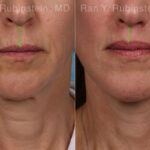 Lip Lift Before and After Photos in Montvale, NJ, Patient 22196