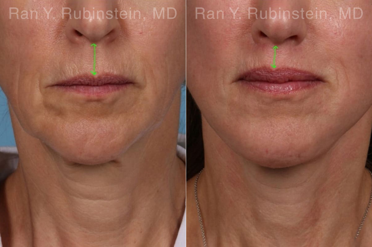 Lip Lift Before and After Photos in Montvale, NJ, Patient 22196