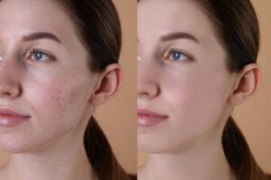 Before and after comparison of a young woman's face showing improved skin texture after Genius RF microneedling treatment.