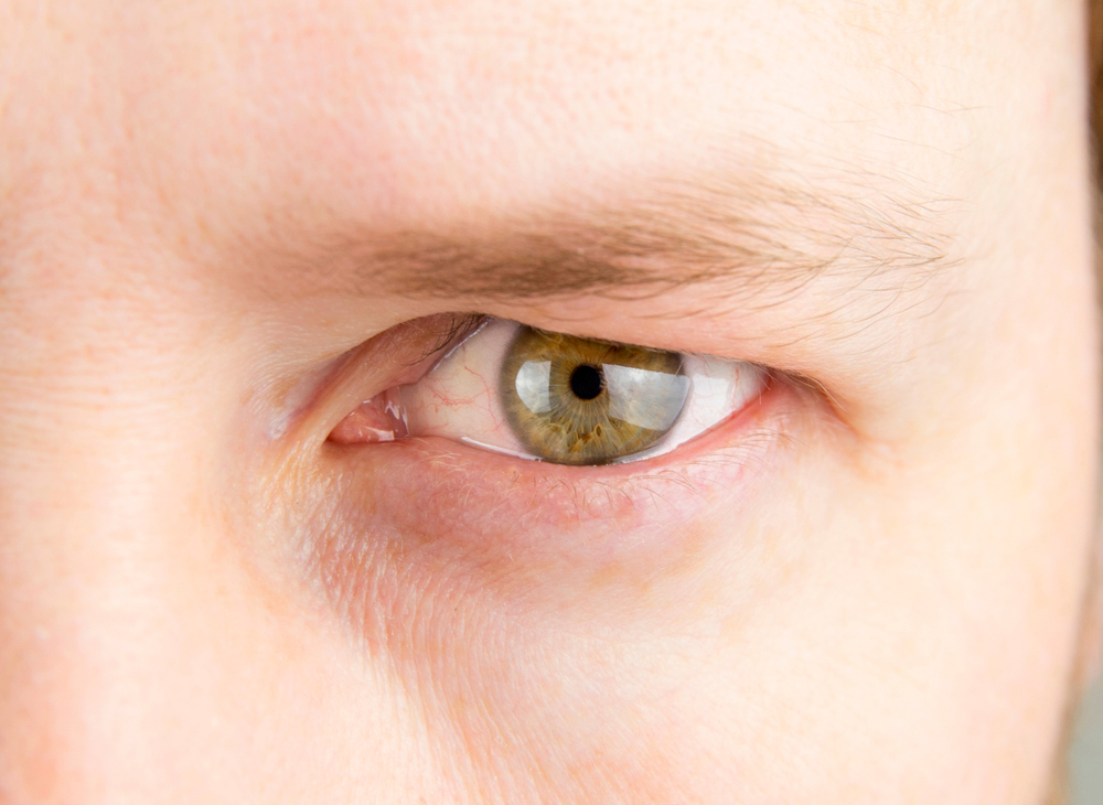 Close-up of an eye with droopy upper eyelid, illustrating vision obstruction caused by ptosis.