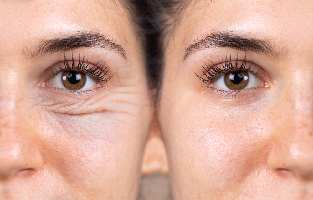 Before and after image showing reduced eyelid wrinkles and puffiness following upper and lower blepharoplasty.
