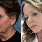 Face lift & Neck lift Before and After Photos in Montvale, NJ, Patient 24825