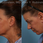 Face lift & Neck lift Before and After Photos in Montvale, NJ, Patient 32263