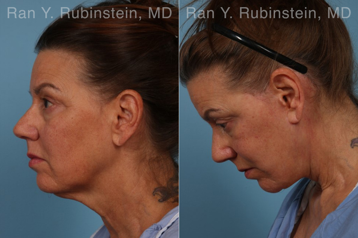 Face lift & Neck lift Before and After Photos in Montvale, NJ, Patient 32263