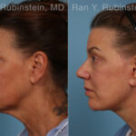 Face lift & Neck lift Before and After Photos in Montvale, NJ, Patient 32263