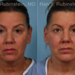 Face lift & Neck lift Before and After Photos in Montvale, NJ, Patient 32263